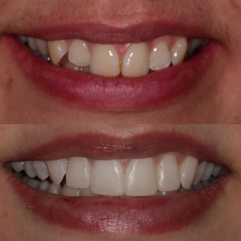 invisalign