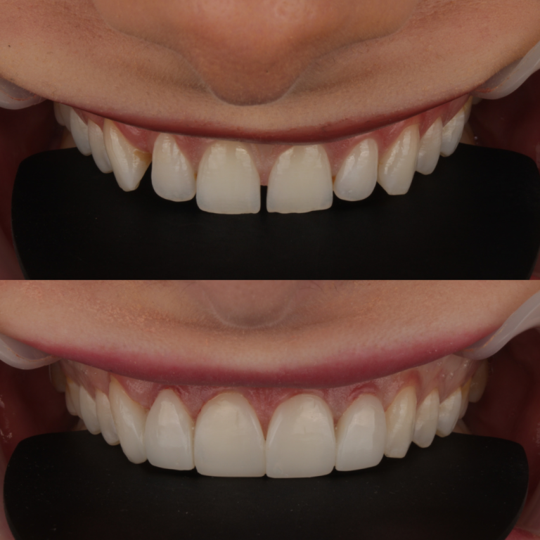 composite bonding