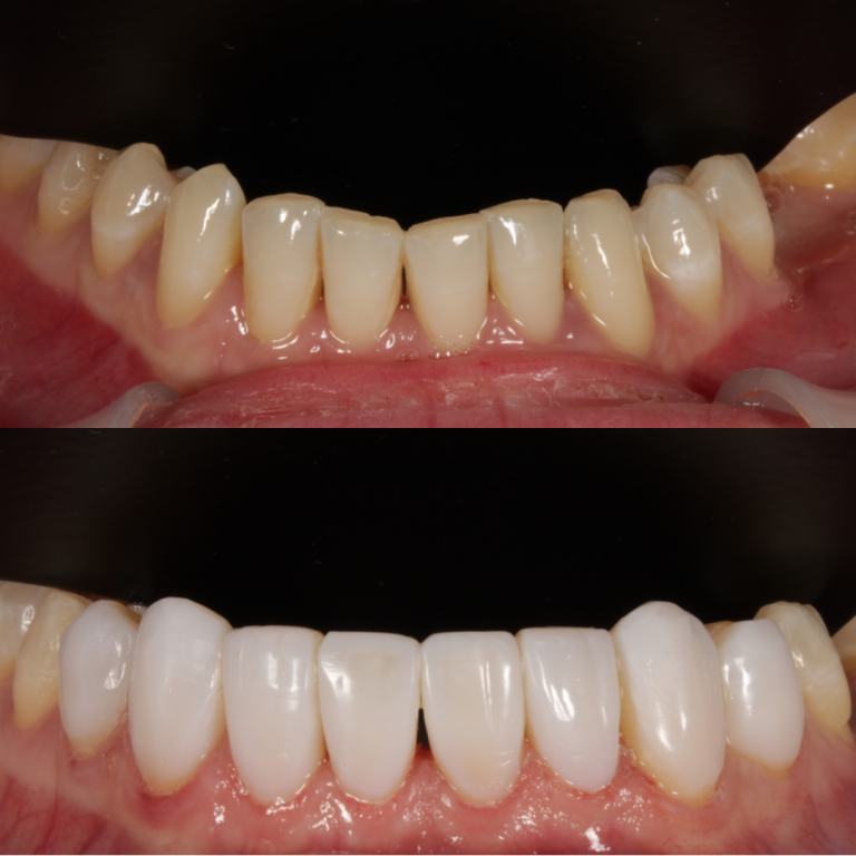 composite bonding
