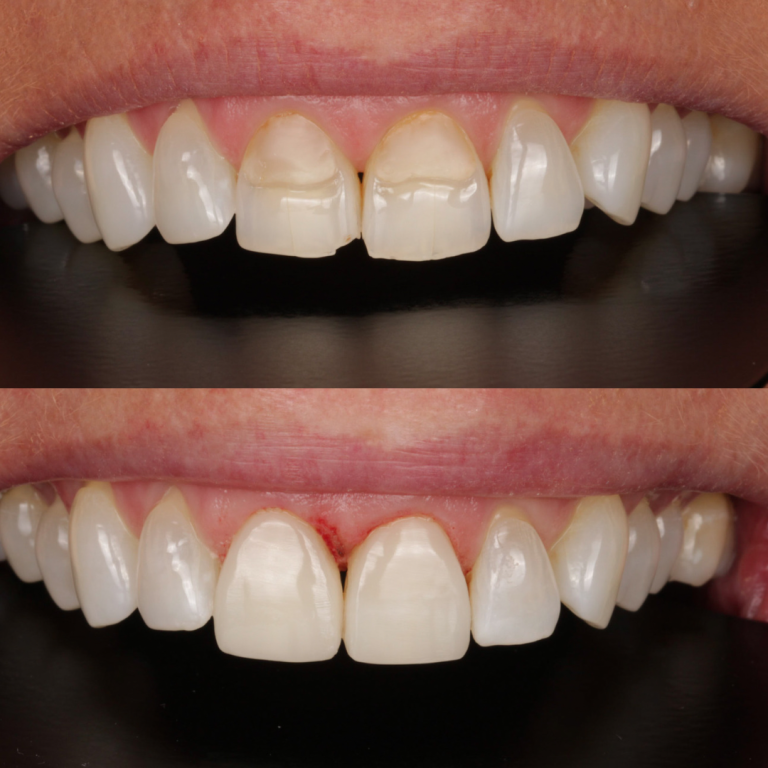 composite bonding