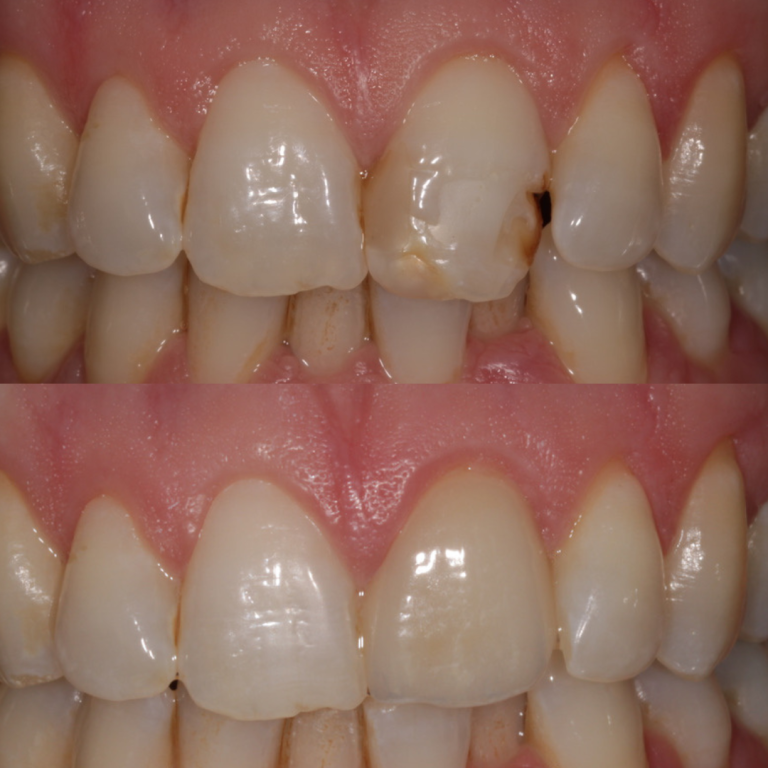 porcelain veneers