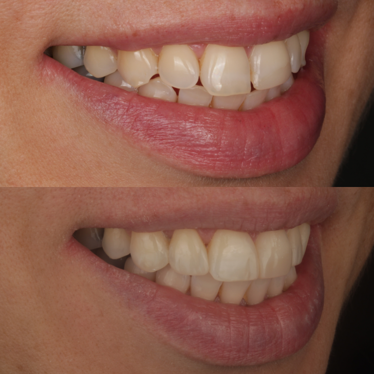 composite bonding