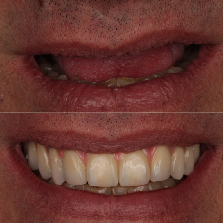 dental implants
