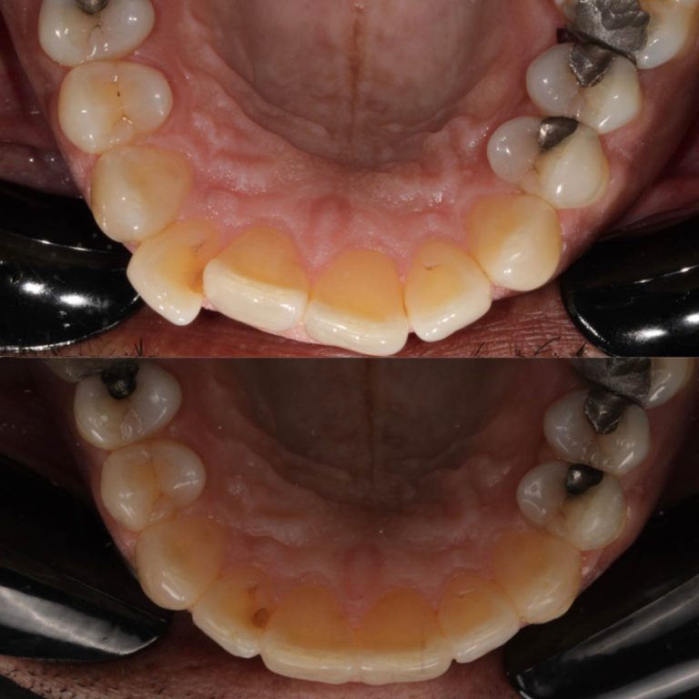 invisalign