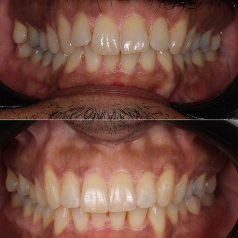 invisalign
