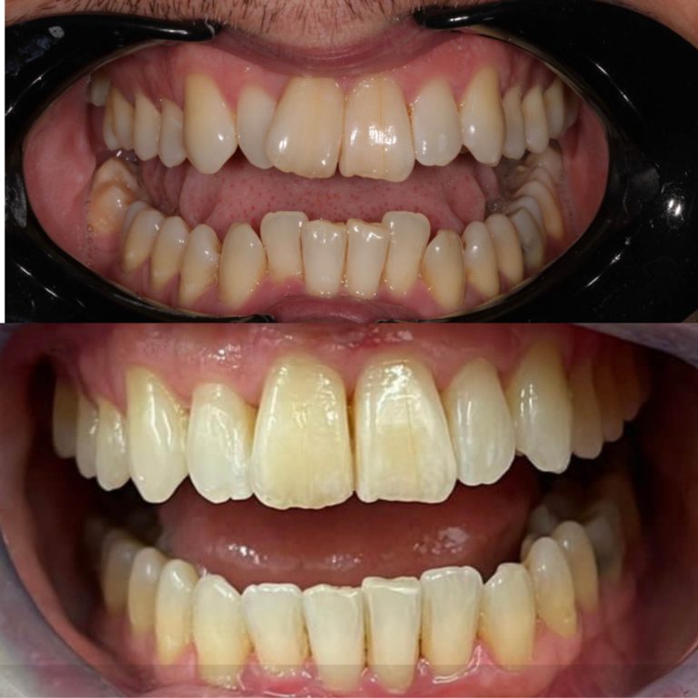 invisalign