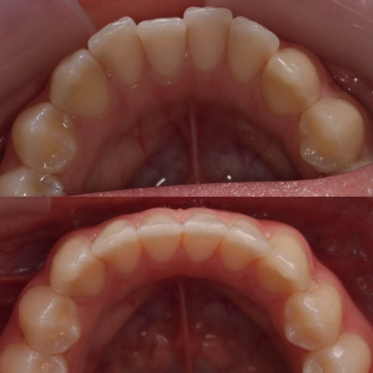 invisalign