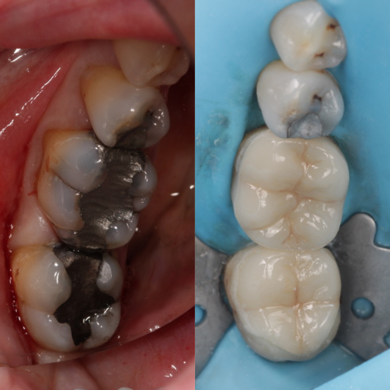 same day crowns