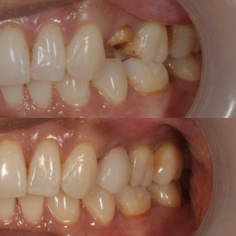 same day crowns