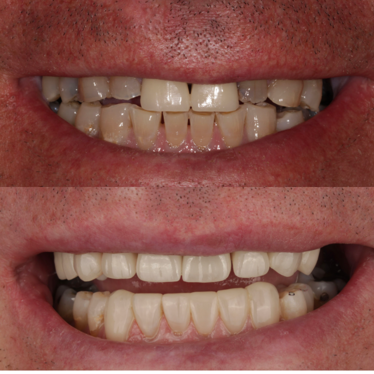 porcelain veneers