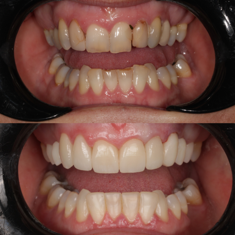 porcelain veneers