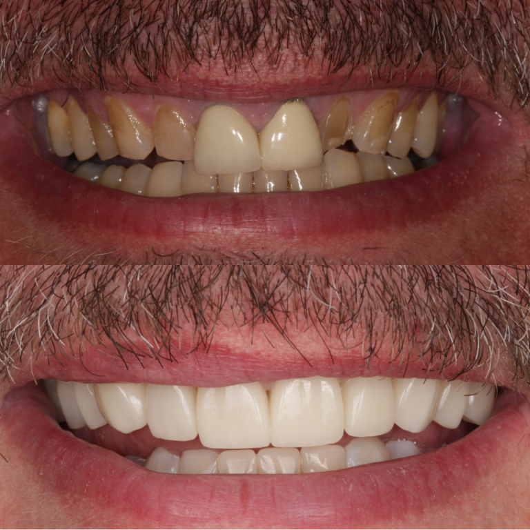 porcelain veneers