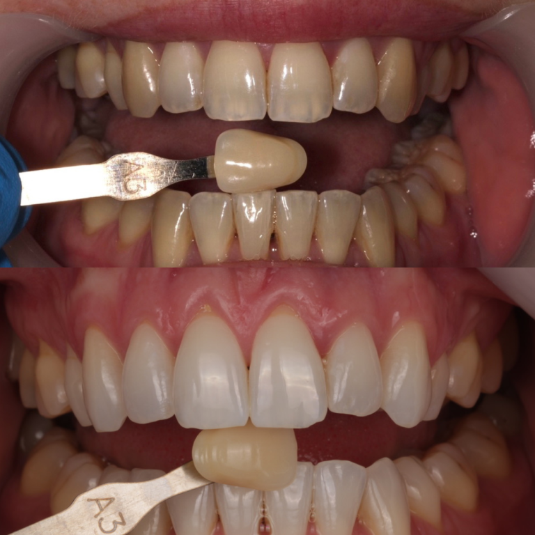 tooth whitening