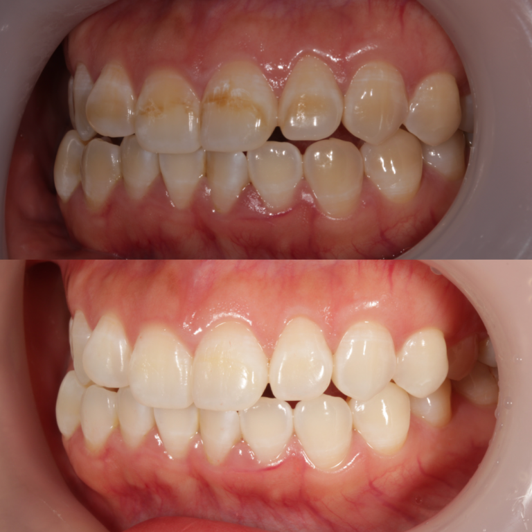 tooth whitening