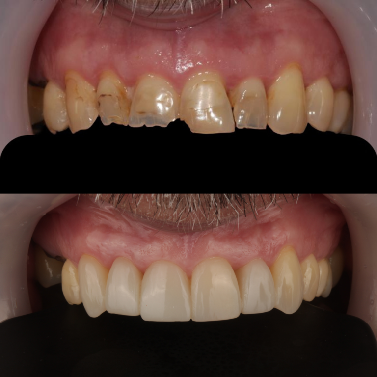 composite bonding