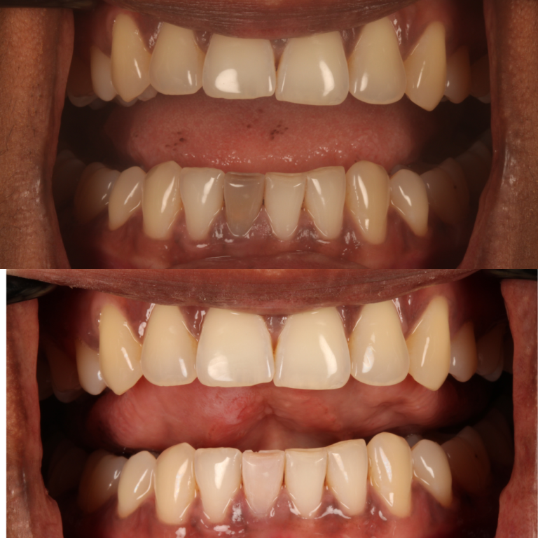 tooth whitening