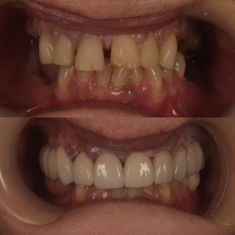 dental implants