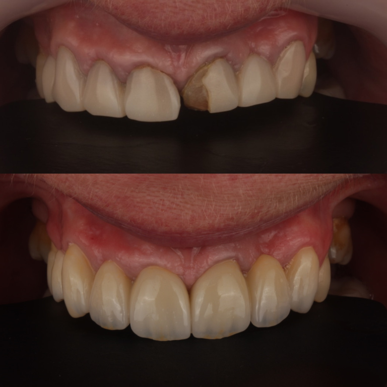 porcelain veneers