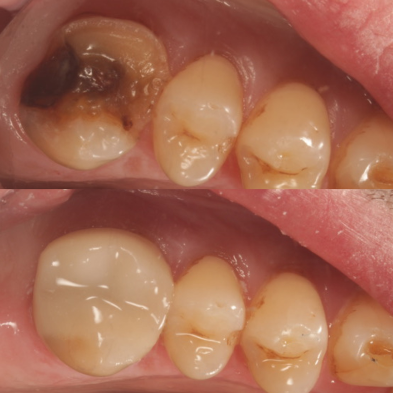 same day crowns