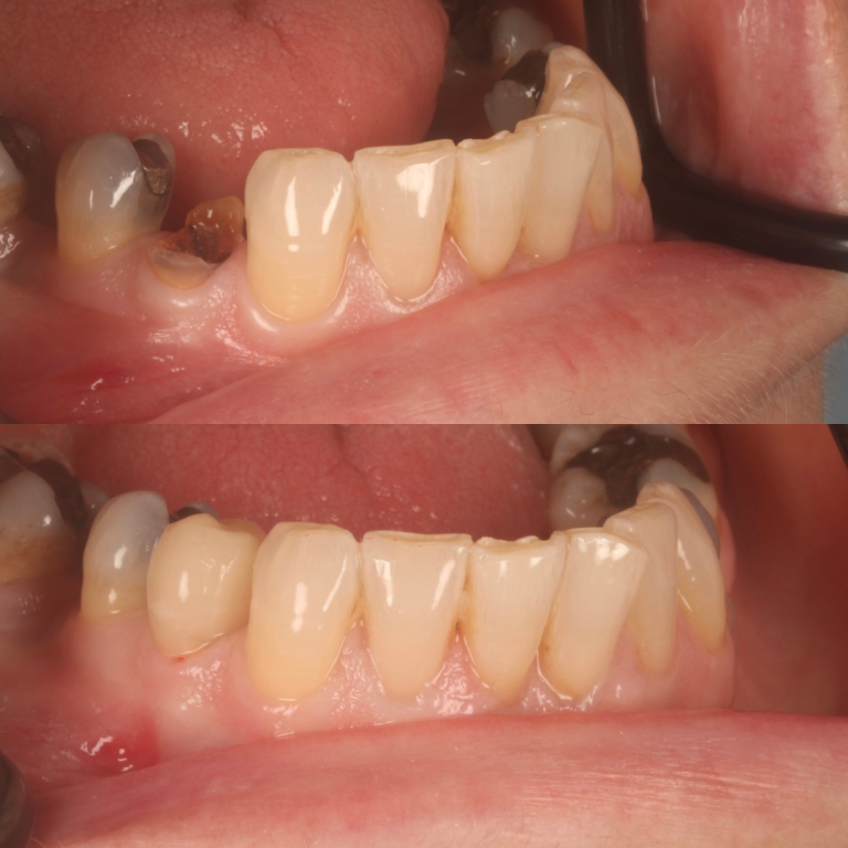 same day crowns