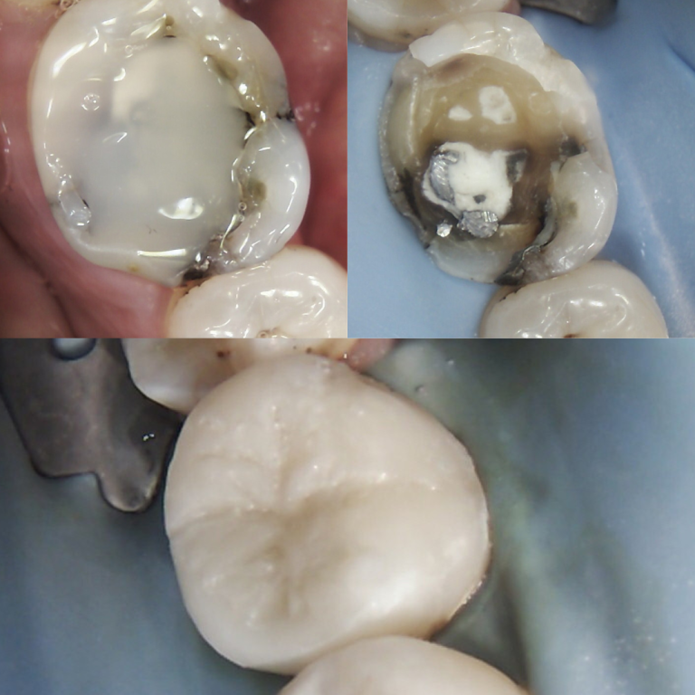 same day crowns