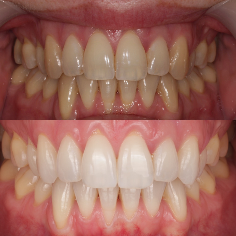 tooth whitening