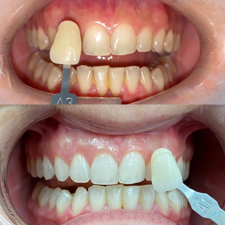tooth whitening